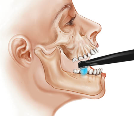 Dr. Price stresses the importance of holding the curing light directly above the restoration to ensure a proper cure